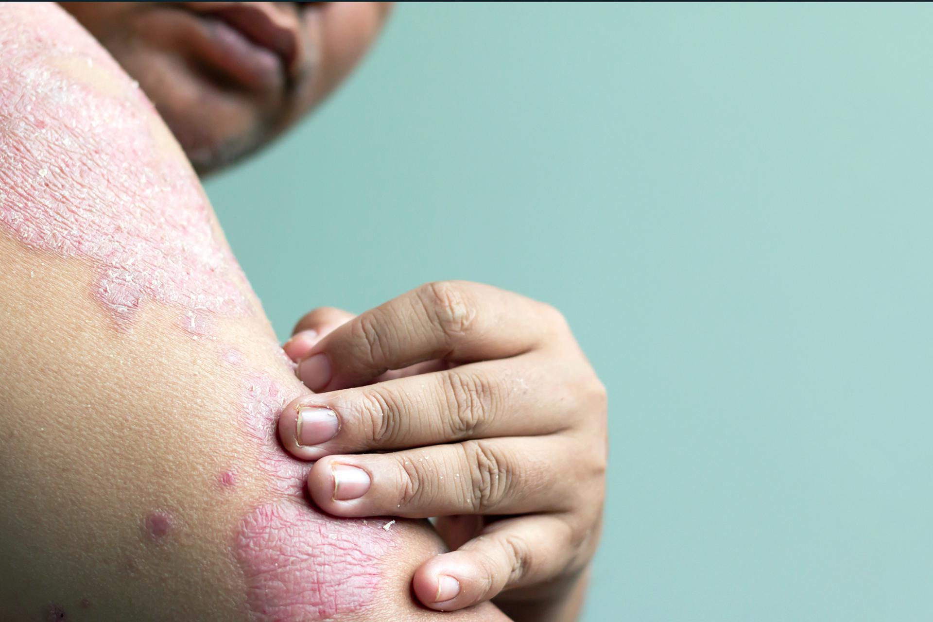 A single topical foam successfully addresses psoriasis on both the body and the scalp
