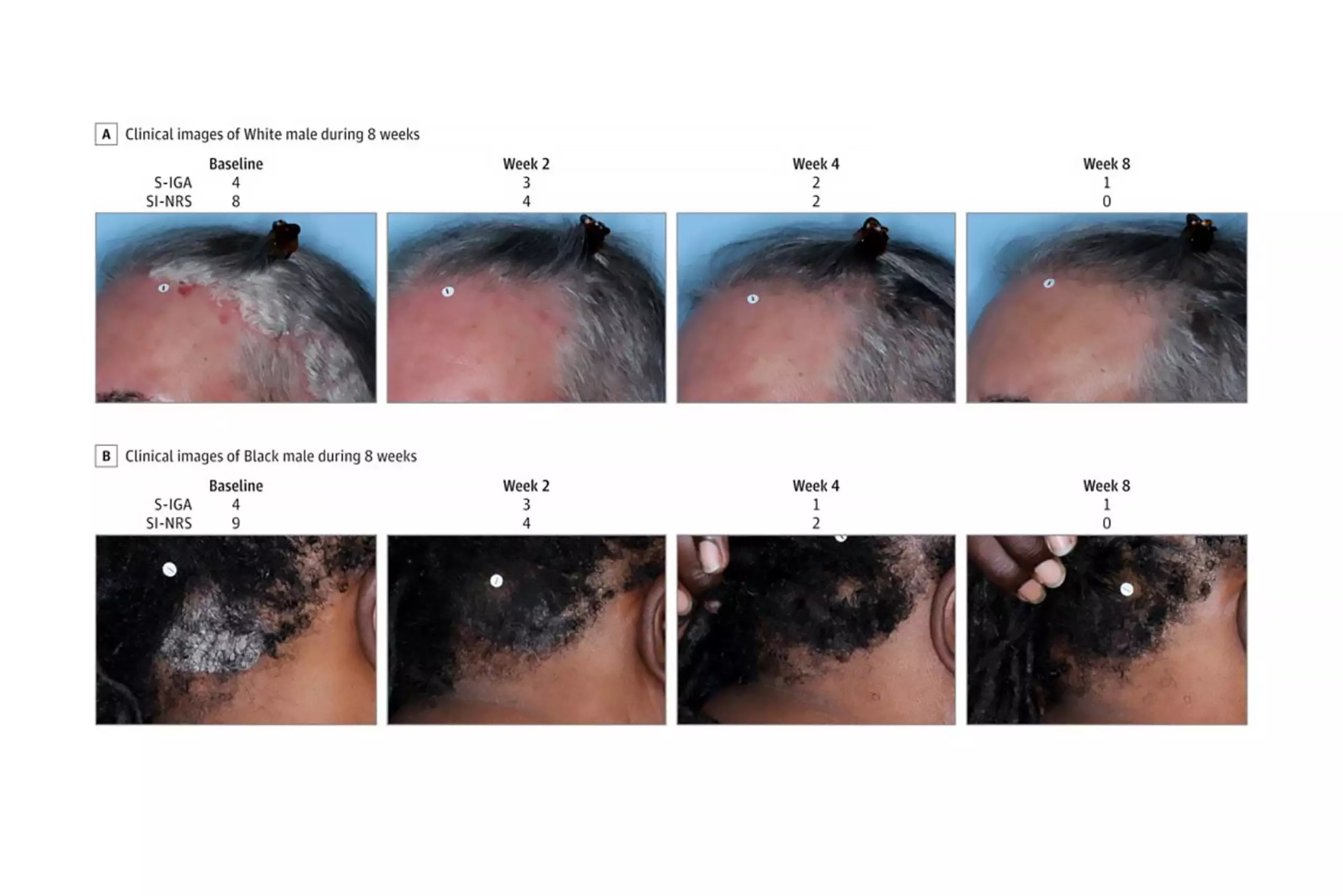 Two trial participants showed improvement in scalp psoriasis after eight weeks of treatment with roflumilast